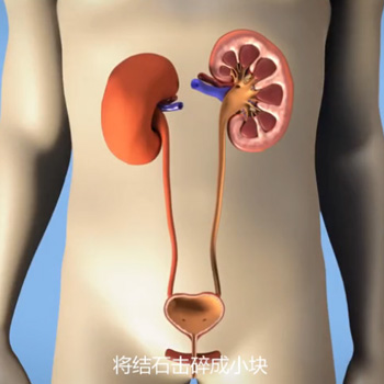 体外冲击波碎石术