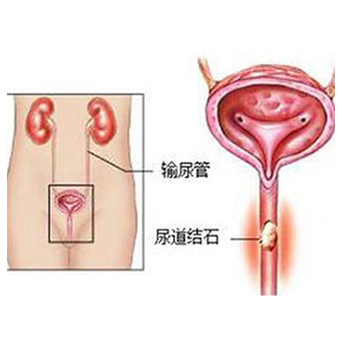 尿道结石